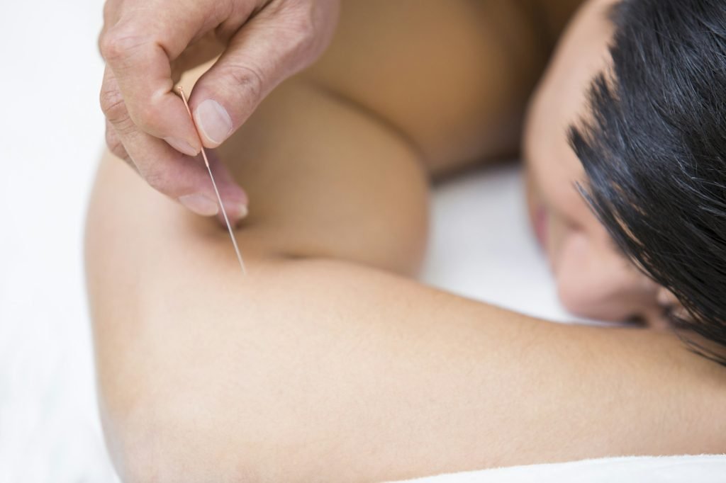 Patient receiving acupuncture